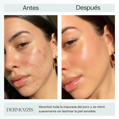 Dermozzis Apósito Corrector Hidrocoloide.