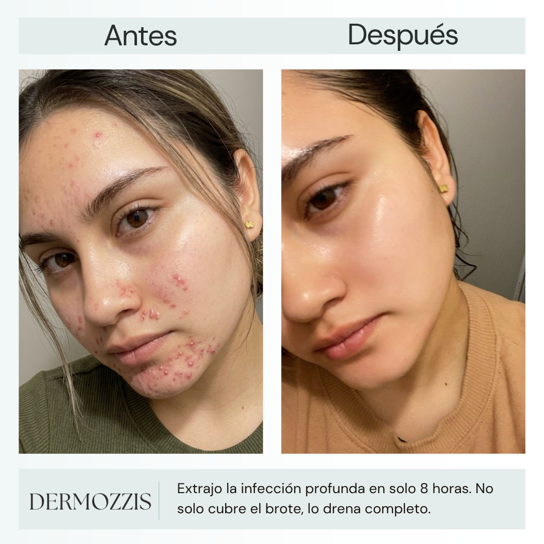 Dermozzis Apósito Corrector Hidrocoloide.
