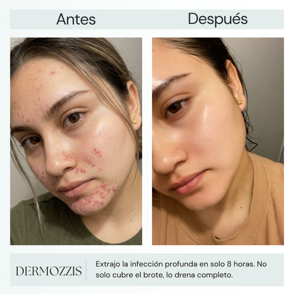 Dermozzis Apósito Corrector Hidrocoloide.